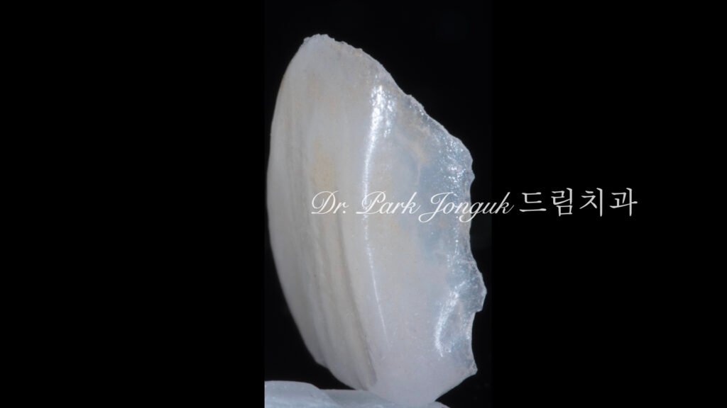 50대 라미네이트, 60대 라미네이트, 중장년층 라미네이트, 치아 누렇게, 법랑질 손실, Enamel Loss, 치아 마모, Tooth Wear, 법랑질 보충, Enamel Replacement, 리튬 디실리케이트, Lithium Disilicate