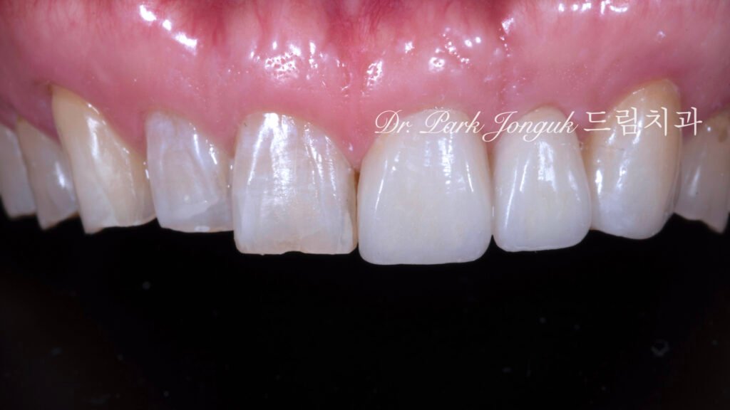 50대 라미네이트, 60대 라미네이트, 중장년층 라미네이트, 치아 누렇게, 법랑질 손실, Enamel Loss, 치아 마모, Tooth Wear, 법랑질 보충, Enamel Replacement, 리튬 디실리케이트, Lithium Disilicate