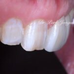 50대 라미네이트, 60대 라미네이트, 중장년층 라미네이트, 치아 누렇게, 법랑질 손실, Enamel Loss, 치아 마모, Tooth Wear, 법랑질 보충, Enamel Replacement, 리튬 디실리케이트, Lithium Disilicate