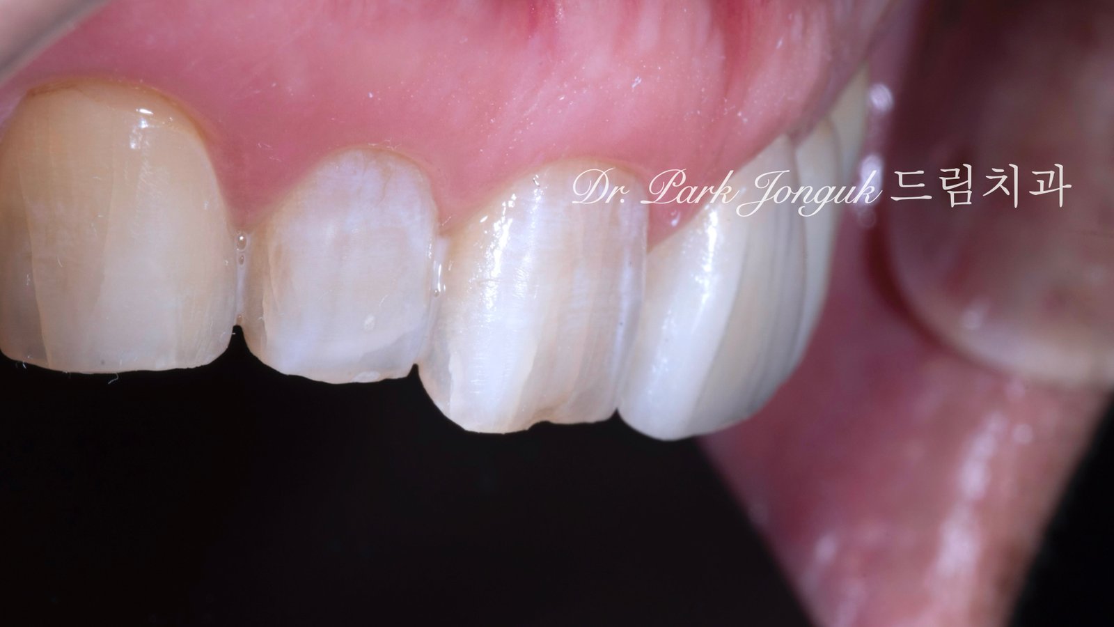 50대 라미네이트, 60대 라미네이트, 중장년층 라미네이트, 치아 누렇게, 법랑질 손실, Enamel Loss, 치아 마모, Tooth Wear, 법랑질 보충, Enamel Replacement, 리튬 디실리케이트, Lithium Disilicate