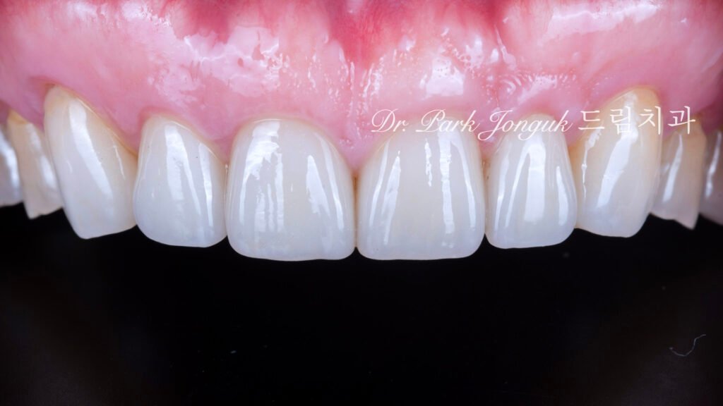 50대 라미네이트, 60대 라미네이트, 중장년층 라미네이트, 치아 누렇게, 법랑질 손실, Enamel Loss, 치아 마모, Tooth Wear, 법랑질 보충, Enamel Replacement, 리튬 디실리케이트, Lithium Disilicate