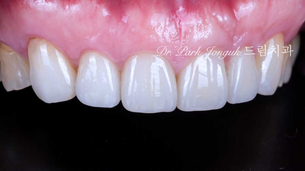 50대 라미네이트, 60대 라미네이트, 중장년층 라미네이트, 치아 누렇게, 법랑질 손실, Enamel Loss, 치아 마모, Tooth Wear, 법랑질 보충, Enamel Replacement, 리튬 디실리케이트, Lithium Disilicate