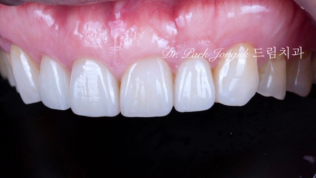 50대 라미네이트, 60대 라미네이트, 중장년층 라미네이트, 치아 누렇게, 법랑질 손실, Enamel Loss, 치아 마모, Tooth Wear, 법랑질 보충, Enamel Replacement, 리튬 디실리케이트, Lithium Disilicate