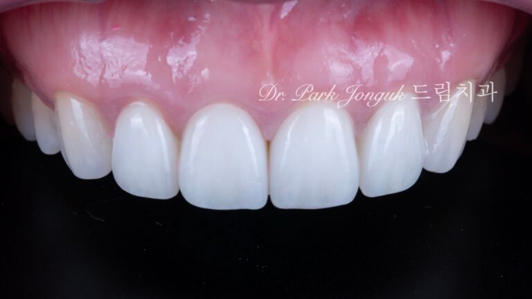 앞니 라미네이트, Anterior Laminate, 라미네이트 티 나요, Artificial Laminate, 자연스러운 라미네이트, Natural Laminate, 라인 앵글, Line Angles, 발육엽, Developmental Lobes, 핸드메이드 빌드업, Hand-Layered Build-up