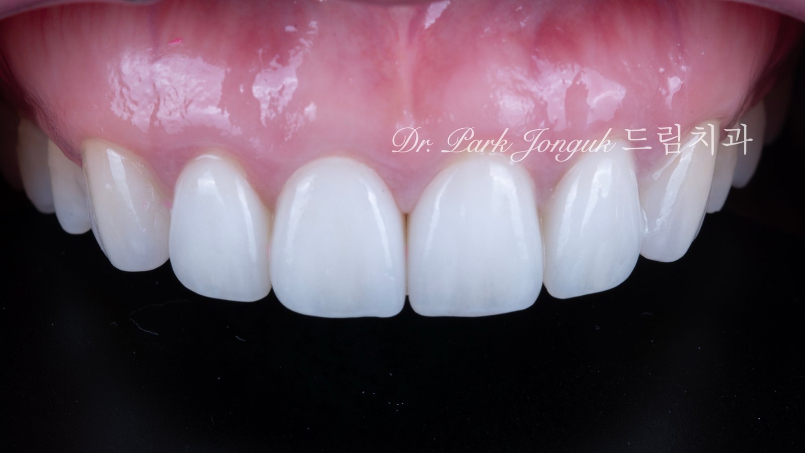 앞니 라미네이트, Anterior Laminate, 라미네이트 티 나요, Artificial Laminate, 자연스러운 라미네이트, Natural Laminate, 라인 앵글, Line Angles, 발육엽, Developmental Lobes, 핸드메이드 빌드업, Hand-Layered Build-up