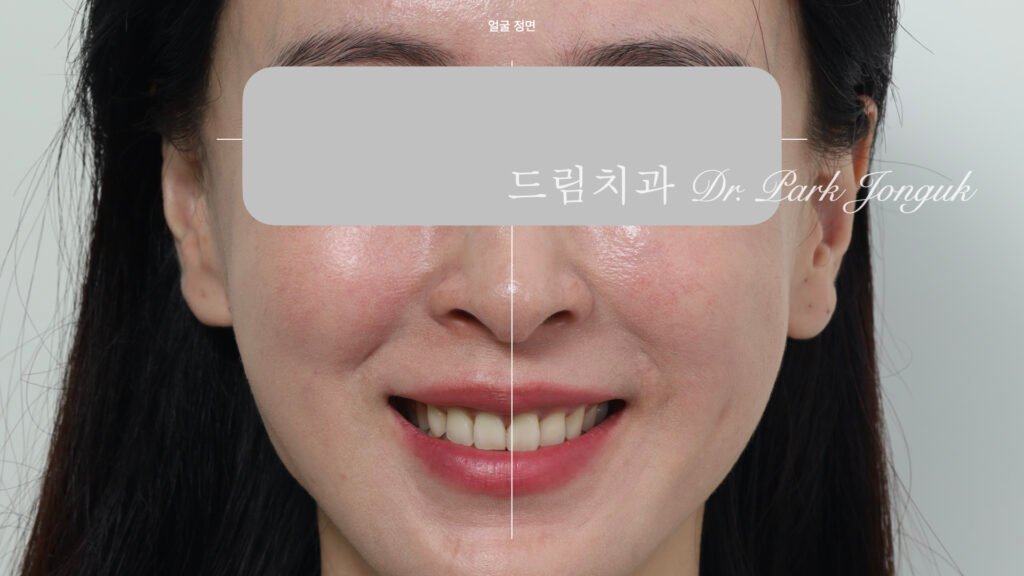 라미네이트 진단, Laminate Diagnosis, 정밀 진단, Precise Diagnosis, 얼굴 분석, Facial Analysis, 치아 비율, Tooth Proportion, 디지털 분석, Digital Analysis, 치료 예측, Treatment Prediction
