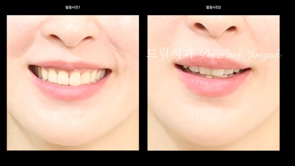 라미네이트 진단, Laminate Diagnosis, 정밀 진단, Precise Diagnosis, 얼굴 분석, Facial Analysis, 치아 비율, Tooth Proportion, 디지털 분석, Digital Analysis, 치료 예측, Treatment Prediction
