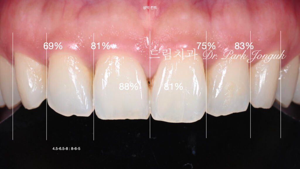 라미네이트 진단, Laminate Diagnosis, 정밀 진단, Precise Diagnosis, 얼굴 분석, Facial Analysis, 치아 비율, Tooth Proportion, 디지털 분석, Digital Analysis, 치료 예측, Treatment Prediction
