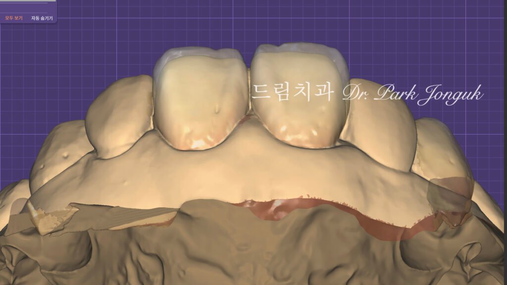 라미네이트 진단, Laminate Diagnosis, 정밀 진단, Precise Diagnosis, 얼굴 분석, Facial Analysis, 치아 비율, Tooth Proportion, 디지털 분석, Digital Analysis, 치료 예측, Treatment Prediction
