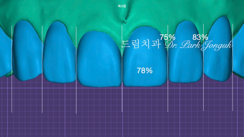 라미네이트 진단, Laminate Diagnosis, 정밀 진단, Precise Diagnosis, 얼굴 분석, Facial Analysis, 치아 비율, Tooth Proportion, 디지털 분석, Digital Analysis, 치료 예측, Treatment Prediction
