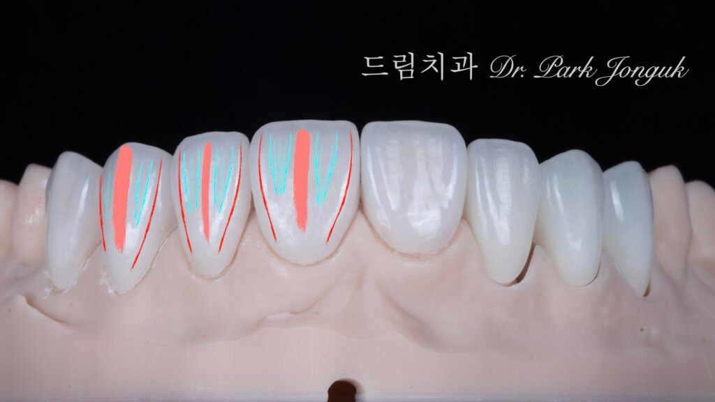 앞니 라미네이트, Anterior Laminate, 라미네이트 티 나요, Artificial Laminate, 자연스러운 라미네이트, Natural Laminate, 라인 앵글, Line Angles, 발육엽, Developmental Lobes, 핸드메이드 빌드업, Hand-Layered Build-up