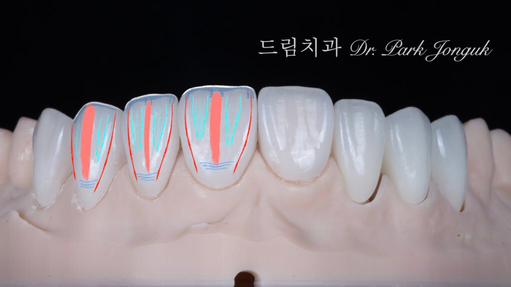 앞니 라미네이트, Anterior Laminate, 라미네이트 티 나요, Artificial Laminate, 자연스러운 라미네이트, Natural Laminate, 라인 앵글, Line Angles, 발육엽, Developmental Lobes, 핸드메이드 빌드업, Hand-Layered Build-up