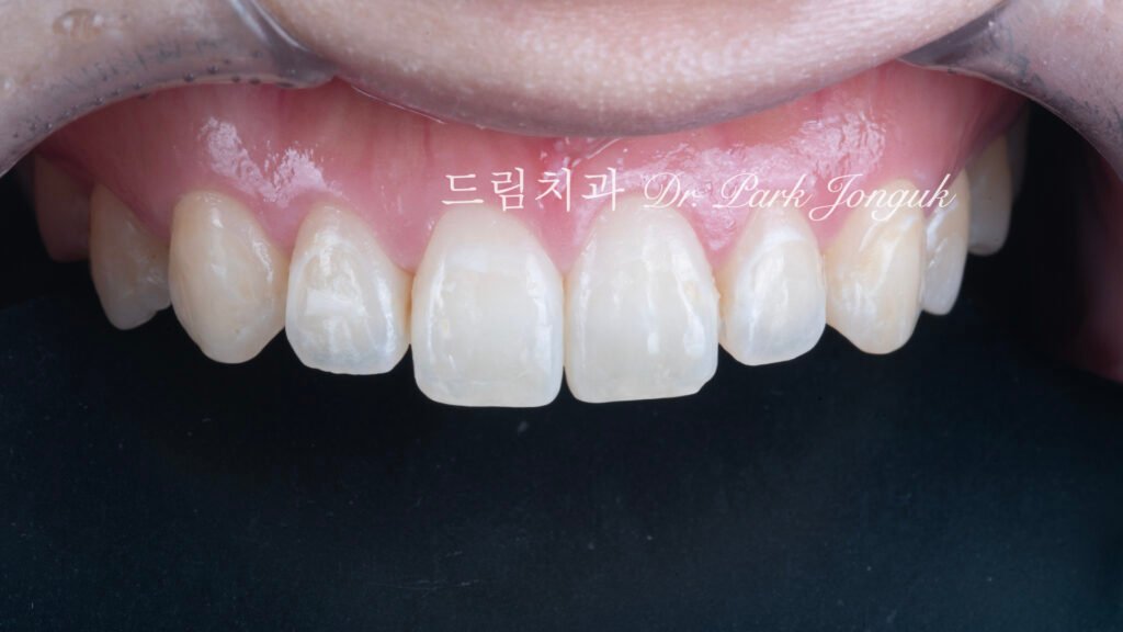 교정 후 라미네이트, Post-Orthodontic Laminate, 무삭제 라미네이트, No-Prep Laminate, 화이트스팟, White Spot Lesions, 초기 우식, Incipient Caries, 표면 질감, Surface Texture