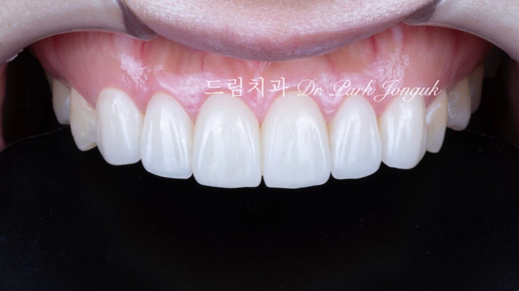 교정 후 라미네이트, Post-Orthodontic Laminate, 무삭제 라미네이트, No-Prep Laminate, 화이트스팟, White Spot Lesions, 초기 우식, Incipient Caries, 표면 질감, Surface Texture