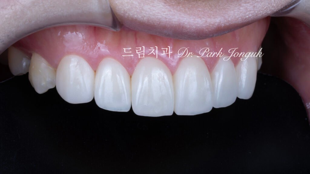 교정 후 라미네이트, Post-Orthodontic Laminate, 무삭제 라미네이트, No-Prep Laminate, 화이트스팟, White Spot Lesions, 초기 우식, Incipient Caries, 표면 질감, Surface Texture