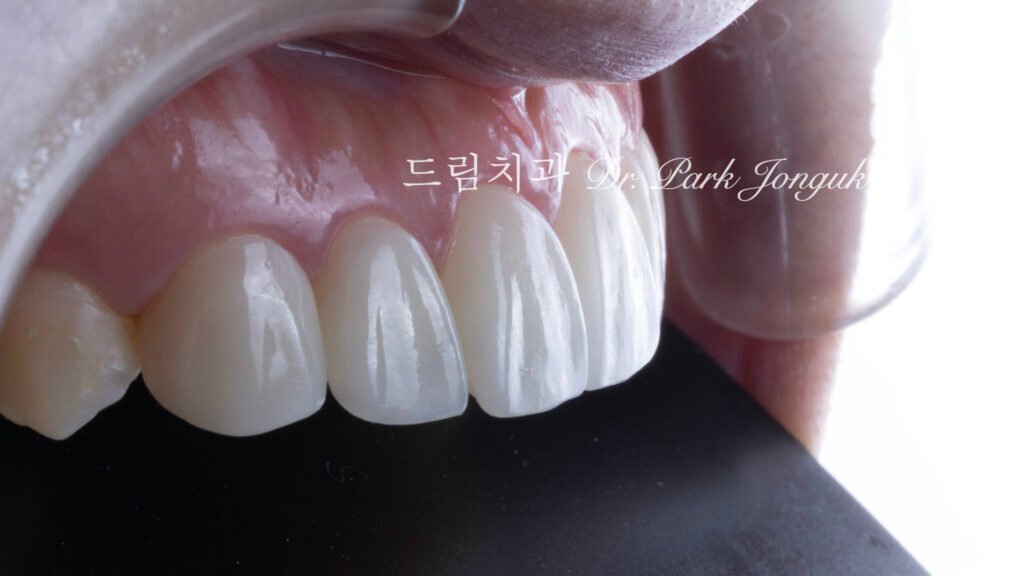 교정 후 라미네이트, Post-Orthodontic Laminate, 무삭제 라미네이트, No-Prep Laminate, 화이트스팟, White Spot Lesions, 초기 우식, Incipient Caries, 표면 질감, Surface Texture