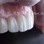 교정 후 라미네이트, Post-Orthodontic Laminate, 무삭제 라미네이트, No-Prep Laminate, 화이트스팟, White Spot Lesions, 초기 우식, Incipient Caries, 표면 질감, Surface Texture