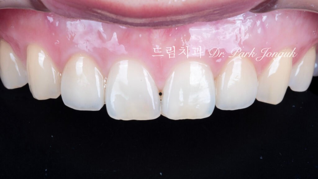 올세라믹 크라운 재시술, All-Ceramic Crown Remake, 무삭제 라미네이트, No-Prep Laminate, 왜소치, Peg-Shaped Lateral Incisors, 라미네이트 재시술, Laminate Remake, 측절치 크라운, Lateral Incisor Crown