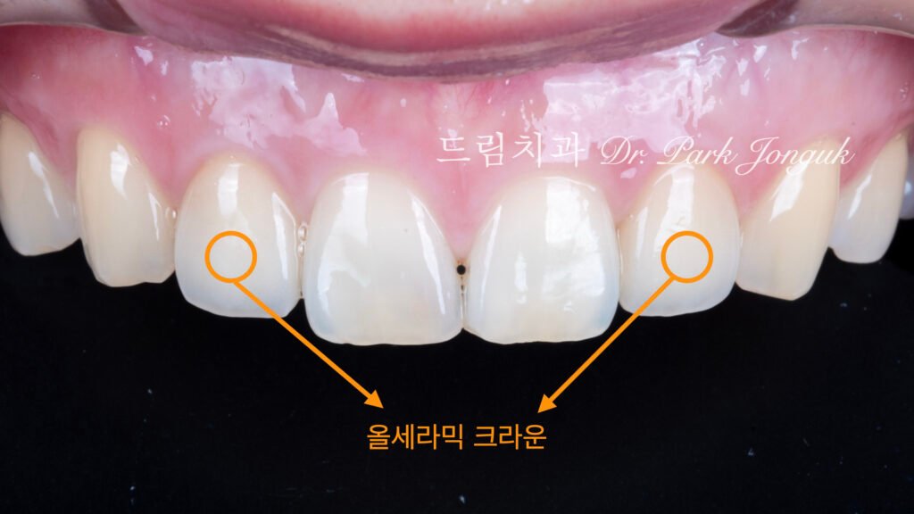 올세라믹 크라운 재시술, All-Ceramic Crown Remake, 무삭제 라미네이트, No-Prep Laminate, 왜소치, Peg-Shaped Lateral Incisors, 라미네이트 재시술, Laminate Remake, 측절치 크라운, Lateral Incisor Crown