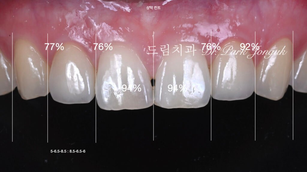 올세라믹 크라운 재시술, All-Ceramic Crown Remake, 무삭제 라미네이트, No-Prep Laminate, 왜소치, Peg-Shaped Lateral Incisors, 라미네이트 재시술, Laminate Remake, 측절치 크라운, Lateral Incisor Crown