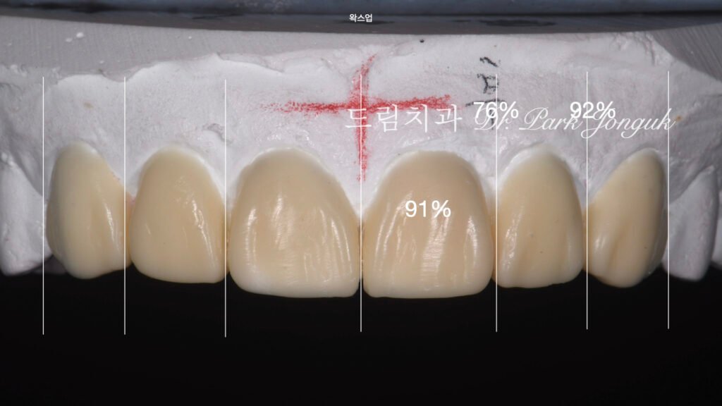 올세라믹 크라운 재시술, All-Ceramic Crown Remake, 무삭제 라미네이트, No-Prep Laminate, 왜소치, Peg-Shaped Lateral Incisors, 라미네이트 재시술, Laminate Remake, 측절치 크라운, Lateral Incisor Crown