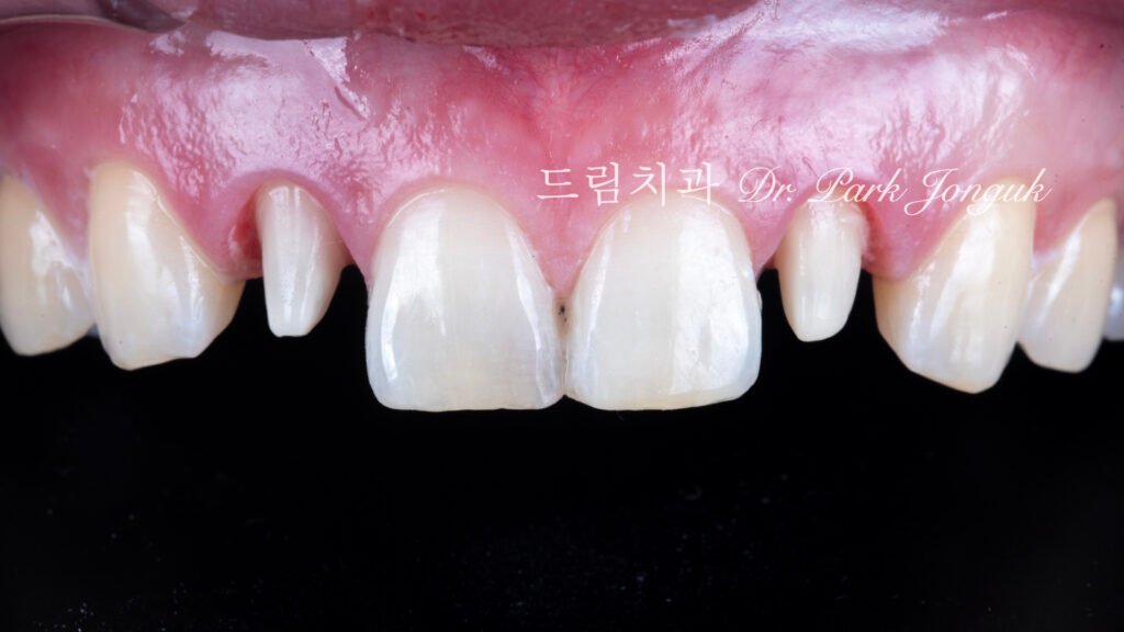 올세라믹 크라운 재시술, All-Ceramic Crown Remake, 무삭제 라미네이트, No-Prep Laminate, 왜소치, Peg-Shaped Lateral Incisors, 라미네이트 재시술, Laminate Remake, 측절치 크라운, Lateral Incisor Crown