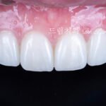 올세라믹 크라운 재시술, All-Ceramic Crown Remake, 무삭제 라미네이트, No-Prep Laminate, 왜소치, Peg-Shaped Lateral Incisors, 라미네이트 재시술, Laminate Remake, 측절치 크라운, Lateral Incisor Crown