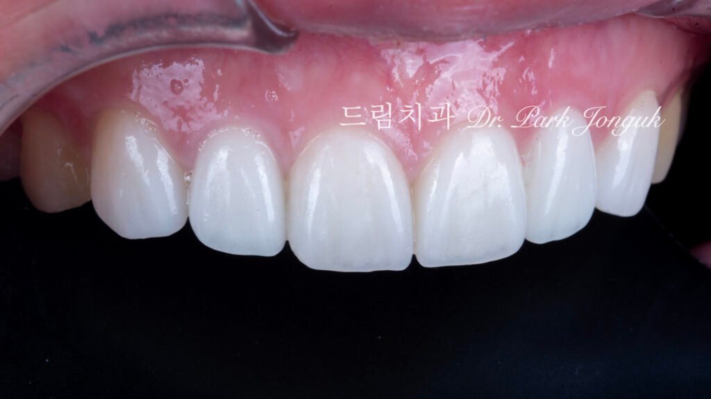 올세라믹 크라운 재시술, All-Ceramic Crown Remake, 무삭제 라미네이트, No-Prep Laminate, 왜소치, Peg-Shaped Lateral Incisors, 라미네이트 재시술, Laminate Remake, 측절치 크라운, Lateral Incisor Crown