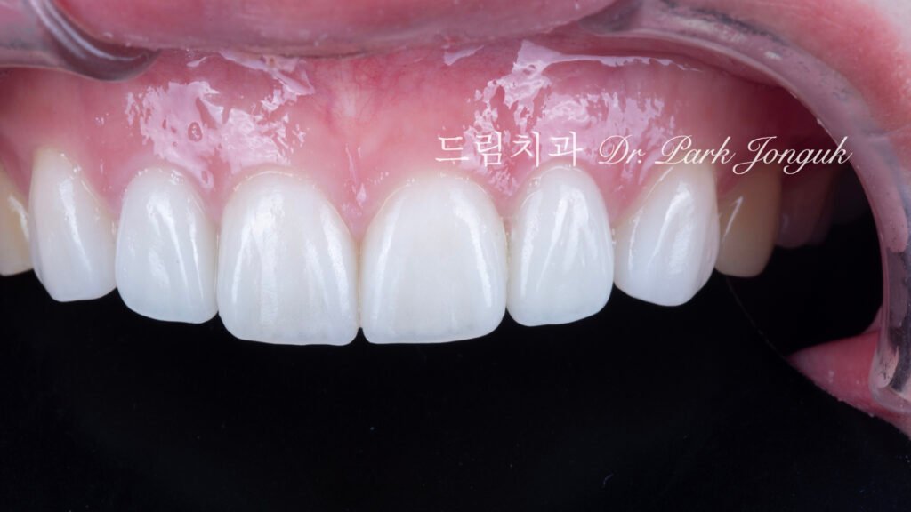 올세라믹 크라운 재시술, All-Ceramic Crown Remake, 무삭제 라미네이트, No-Prep Laminate, 왜소치, Peg-Shaped Lateral Incisors, 라미네이트 재시술, Laminate Remake, 측절치 크라운, Lateral Incisor Crown