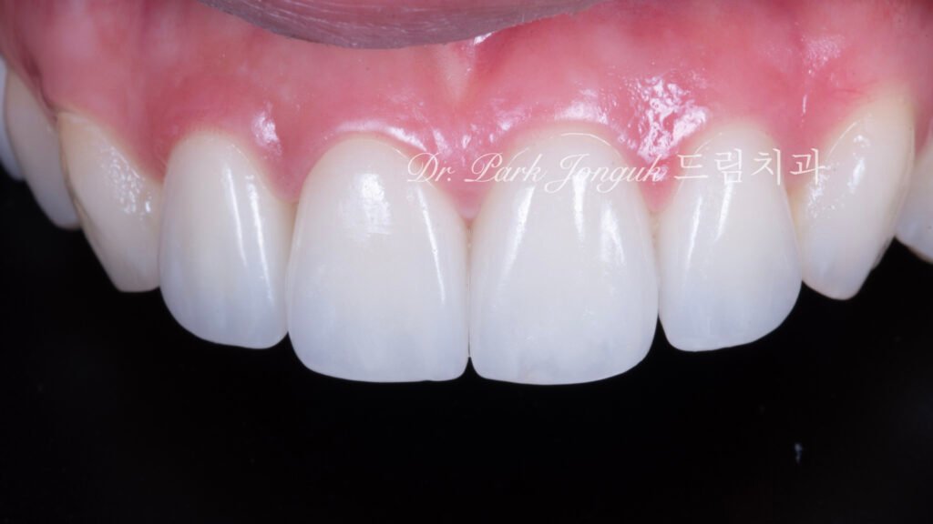 라미네이트 진단, Laminate Diagnosis, 정밀 진단, Precise Diagnosis, 얼굴 분석, Facial Analysis, 치아 비율, Tooth Proportion, 디지털 분석, Digital Analysis, 치료 예측, Treatment Prediction
