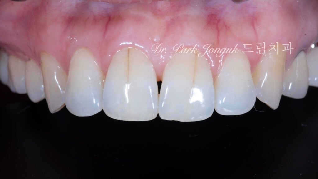 앞니 라미네이트, Anterior Laminate Veneer, 라미네이트 잘하는 곳, Expert Laminate Clinic, 자연스러운 라미네이트, Natural Laminate, 다층 빌드업, Multi-Layer Build-Up, 백금박 라미네이트, Platinum Foil Veneer