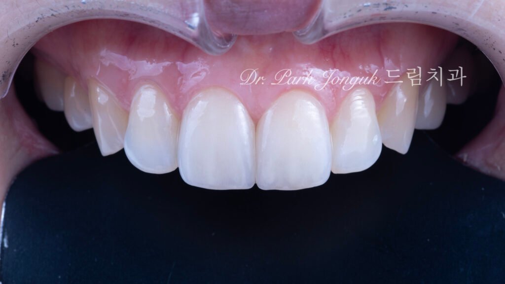 앞니 라미네이트, Anterior Laminate Veneer, 라미네이트 잘하는 곳, Expert Laminate Clinic, 자연스러운 라미네이트, Natural Laminate, 다층 빌드업, Multi-Layer Build-Up, 백금박 라미네이트, Platinum Foil Veneer