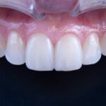 앞니 라미네이트, Anterior Laminate Veneer, 라미네이트 잘하는 곳, Expert Laminate Clinic, 자연스러운 라미네이트, Natural Laminate, 다층 빌드업, Multi-Layer Build-Up, 백금박 라미네이트, Platinum Foil Veneer