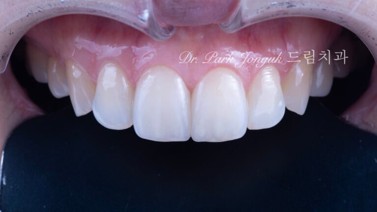 앞니 라미네이트, Anterior Laminate Veneer, 라미네이트 잘하는 곳, Expert Laminate Clinic, 자연스러운 라미네이트, Natural Laminate, 다층 빌드업, Multi-Layer Build-Up, 백금박 라미네이트, Platinum Foil Veneer