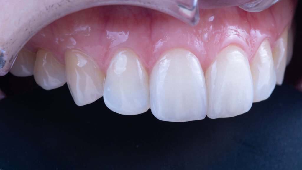 앞니 라미네이트, Anterior Laminate Veneer, 라미네이트 잘하는 곳, Expert Laminate Clinic, 자연스러운 라미네이트, Natural Laminate, 다층 빌드업, Multi-Layer Build-Up, 백금박 라미네이트, Platinum Foil Veneer