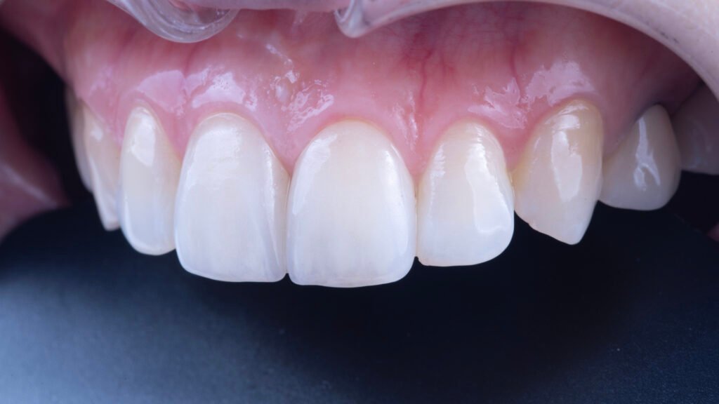 앞니 라미네이트, Anterior Laminate Veneer, 라미네이트 잘하는 곳, Expert Laminate Clinic, 자연스러운 라미네이트, Natural Laminate, 다층 빌드업, Multi-Layer Build-Up, 백금박 라미네이트, Platinum Foil Veneer