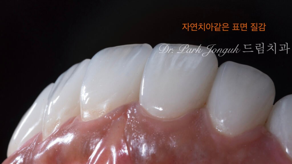 앞니 라미네이트, Anterior Laminate, 라미네이트 티 나요, Artificial Laminate, 자연스러운 라미네이트, Natural Laminate, 라인 앵글, Line Angles, 발육엽, Developmental Lobes, 핸드메이드 빌드업, Hand-Layered Build-up