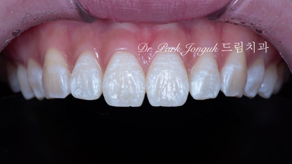 선천적 치아 변색, Congenital Tooth Discoloration, 치아 얼룩, Tooth Mottling, 내인성 변색, Intrinsic Discoloration, 미백 한계, Bleaching Limitation, 변색 차단 라미네이트, Discoloration Masking Veneer