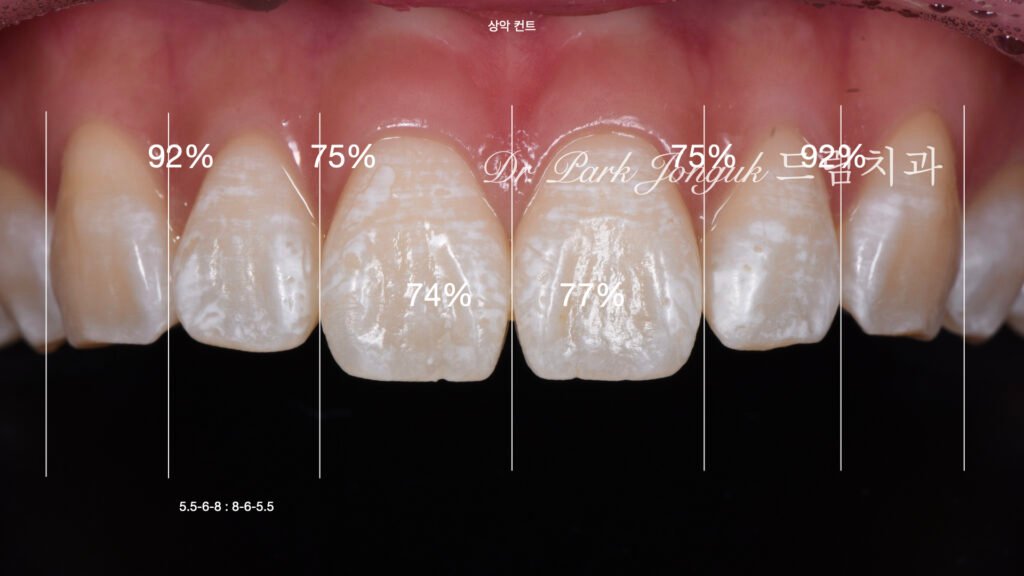 선천적 치아 변색, Congenital Tooth Discoloration, 치아 얼룩, Tooth Mottling, 내인성 변색, Intrinsic Discoloration, 미백 한계, Bleaching Limitation, 변색 차단 라미네이트, Discoloration Masking Veneer