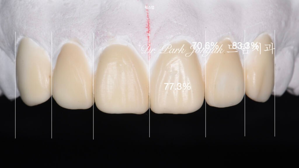 선천적 치아 변색, Congenital Tooth Discoloration, 치아 얼룩, Tooth Mottling, 내인성 변색, Intrinsic Discoloration, 미백 한계, Bleaching Limitation, 변색 차단 라미네이트, Discoloration Masking Veneer