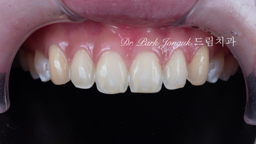 선천적 치아 변색, Congenital Tooth Discoloration, 치아 얼룩, Tooth Mottling, 내인성 변색, Intrinsic Discoloration, 미백 한계, Bleaching Limitation, 변색 차단 라미네이트, Discoloration Masking Veneer