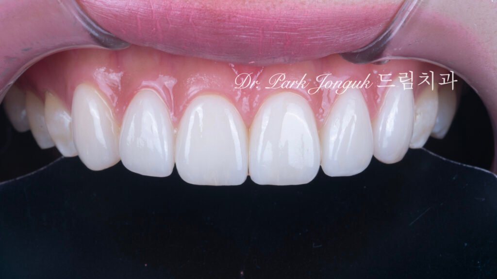 선천적 치아 변색, Congenital Tooth Discoloration, 치아 얼룩, Tooth Mottling, 내인성 변색, Intrinsic Discoloration, 미백 한계, Bleaching Limitation, 변색 차단 라미네이트, Discoloration Masking Veneer