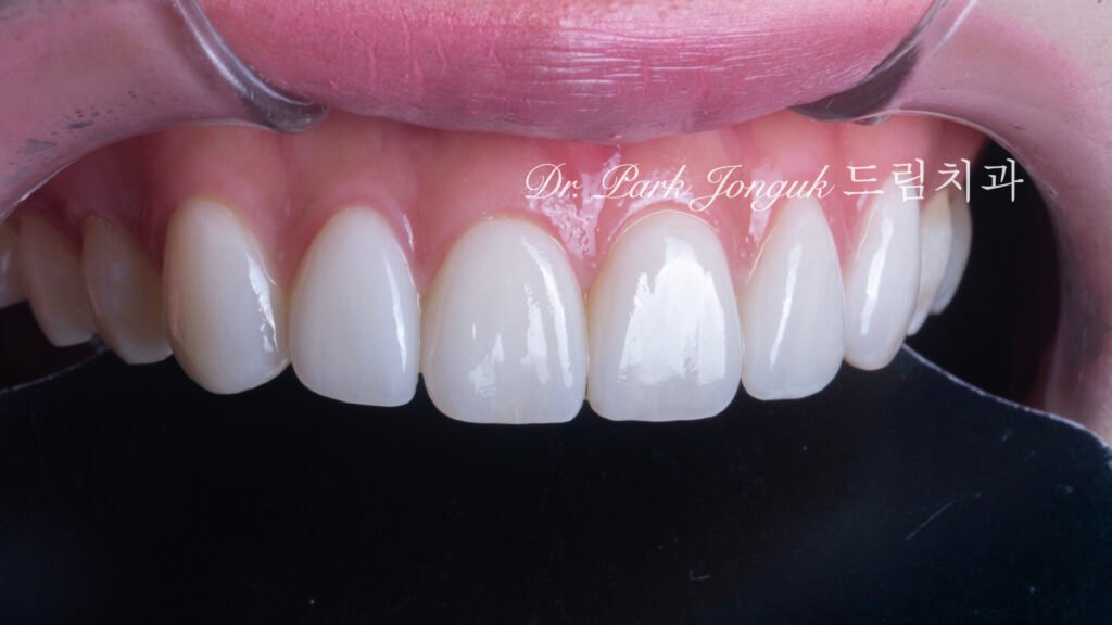 선천적 치아 변색, Congenital Tooth Discoloration, 치아 얼룩, Tooth Mottling, 내인성 변색, Intrinsic Discoloration, 미백 한계, Bleaching Limitation, 변색 차단 라미네이트, Discoloration Masking Veneer