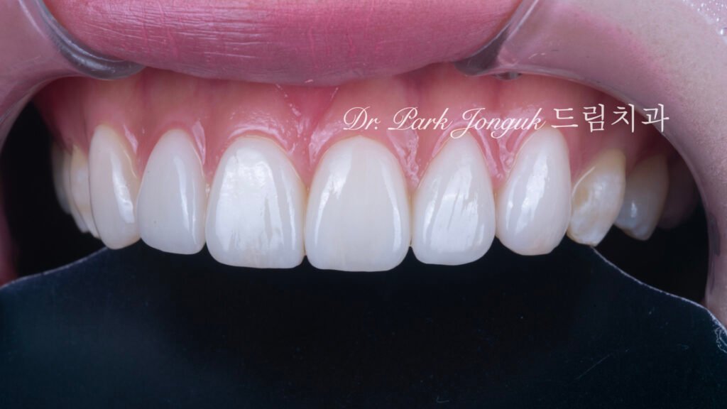 선천적 치아 변색, Congenital Tooth Discoloration, 치아 얼룩, Tooth Mottling, 내인성 변색, Intrinsic Discoloration, 미백 한계, Bleaching Limitation, 변색 차단 라미네이트, Discoloration Masking Veneer