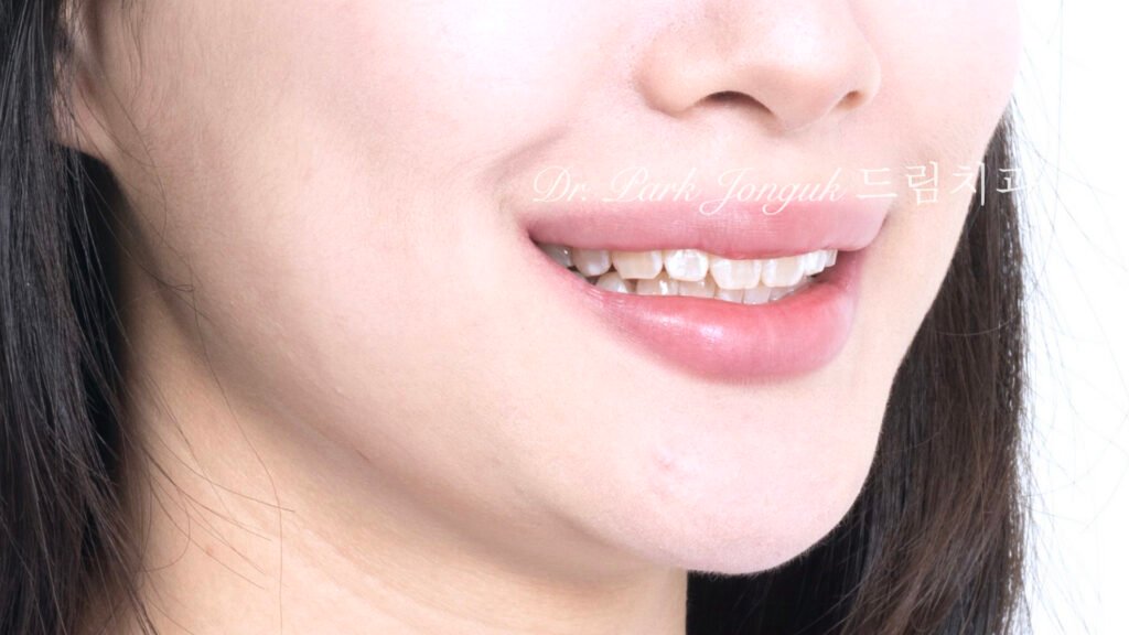 선천적 치아 변색, Congenital Tooth Discoloration, 치아 얼룩, Tooth Mottling, 내인성 변색, Intrinsic Discoloration, 미백 한계, Bleaching Limitation, 변색 차단 라미네이트, Discoloration Masking Veneer