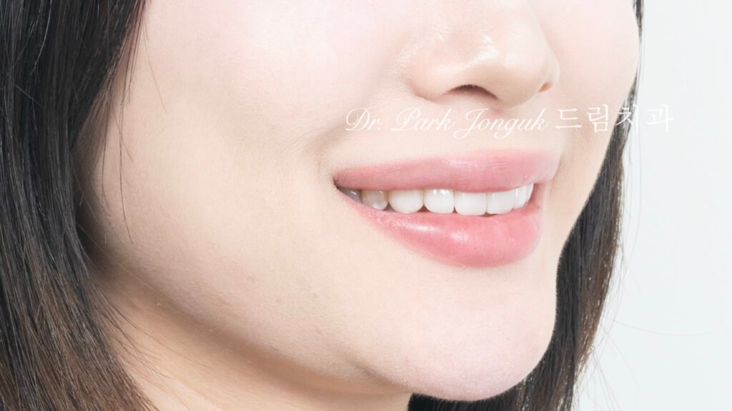 선천적 치아 변색, Congenital Tooth Discoloration, 치아 얼룩, Tooth Mottling, 내인성 변색, Intrinsic Discoloration, 미백 한계, Bleaching Limitation, 변색 차단 라미네이트, Discoloration Masking Veneer