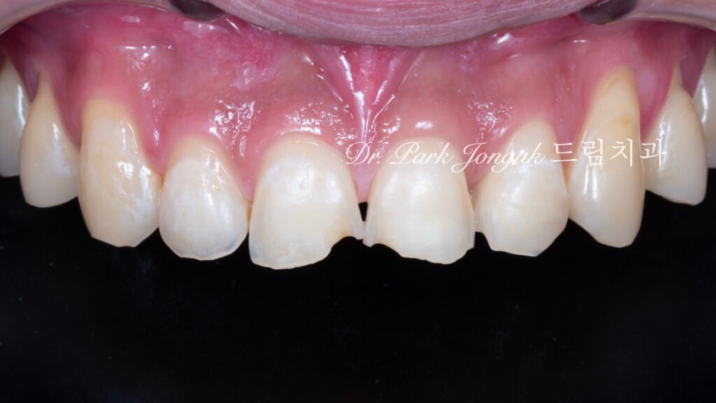 깨진 치아 라미네이트, Laminate for Fractured Teeth, 부식된 치아, Eroded Teeth, 역류성 식도염, GERD, 샌드위치 테크닉, Sandwich Technique, 무삭제 라미네이트, No-Prep Laminate, 교정 후 라미네이트, Post-Orthodontic Laminate