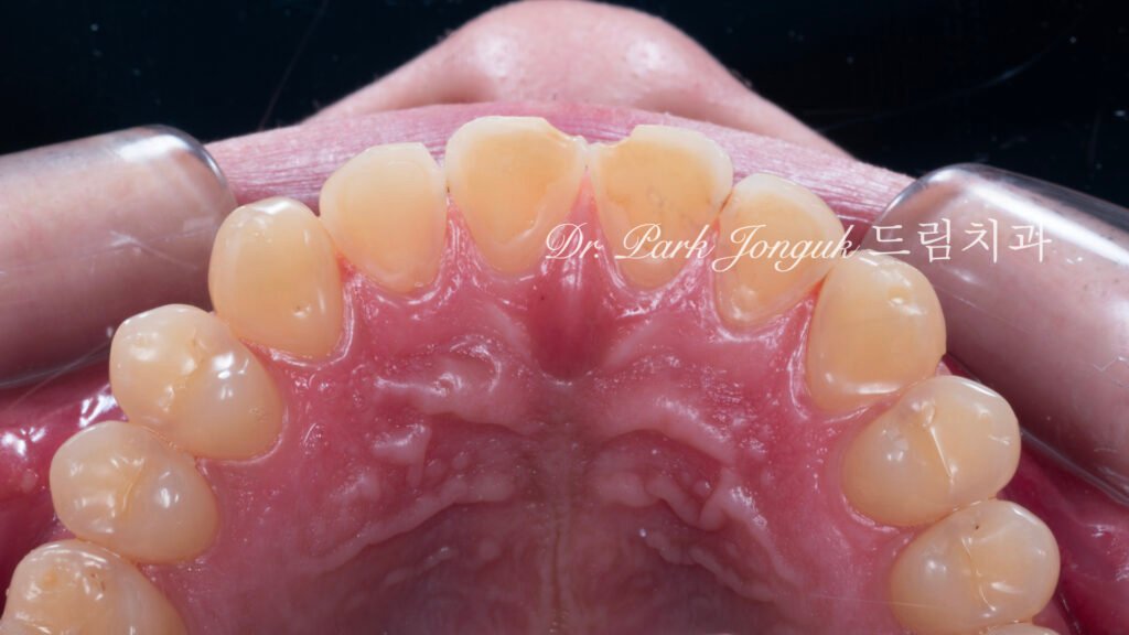 깨진 치아 라미네이트, Laminate for Fractured Teeth, 부식된 치아, Eroded Teeth, 역류성 식도염, GERD, 샌드위치 테크닉, Sandwich Technique, 무삭제 라미네이트, No-Prep Laminate, 교정 후 라미네이트, Post-Orthodontic Laminate