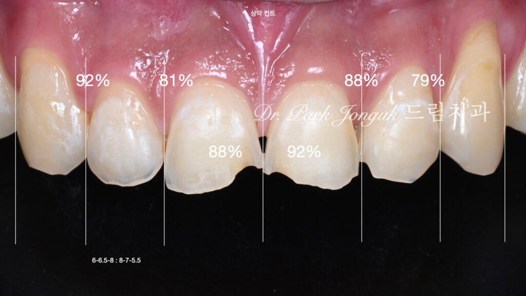 깨진 치아 라미네이트, Laminate for Fractured Teeth, 부식된 치아, Eroded Teeth, 역류성 식도염, GERD, 샌드위치 테크닉, Sandwich Technique, 무삭제 라미네이트, No-Prep Laminate, 교정 후 라미네이트, Post-Orthodontic Laminate