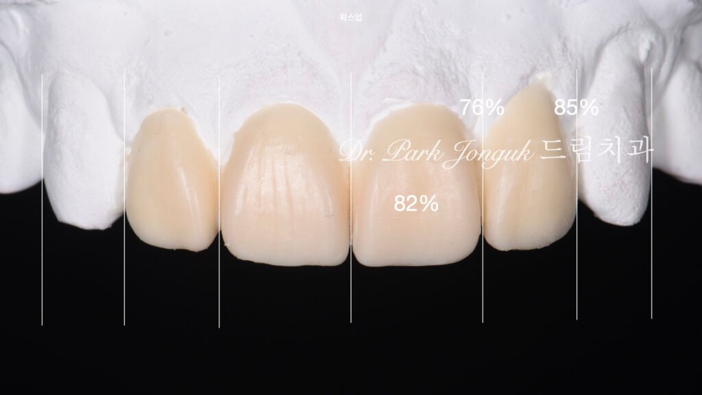깨진 치아 라미네이트, Laminate for Fractured Teeth, 부식된 치아, Eroded Teeth, 역류성 식도염, GERD, 샌드위치 테크닉, Sandwich Technique, 무삭제 라미네이트, No-Prep Laminate, 교정 후 라미네이트, Post-Orthodontic Laminate